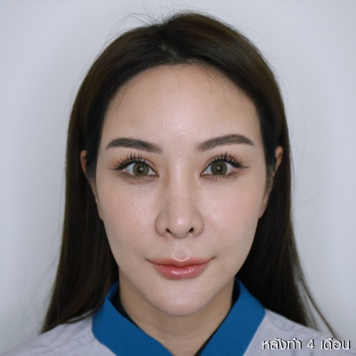 ดูดไขมันเหนียงใต้คาง (FaceTite)