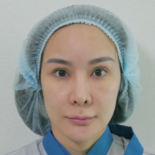 ดูดไขมันเหนียงใต้คาง (FaceTite)