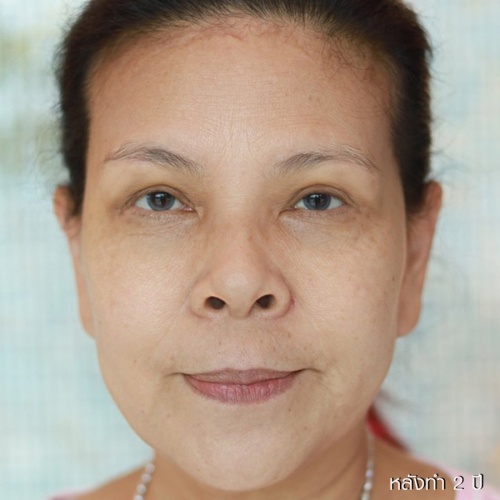 ดึงหน้า