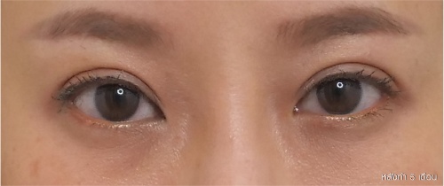 หนังตา/หางตาบนตก