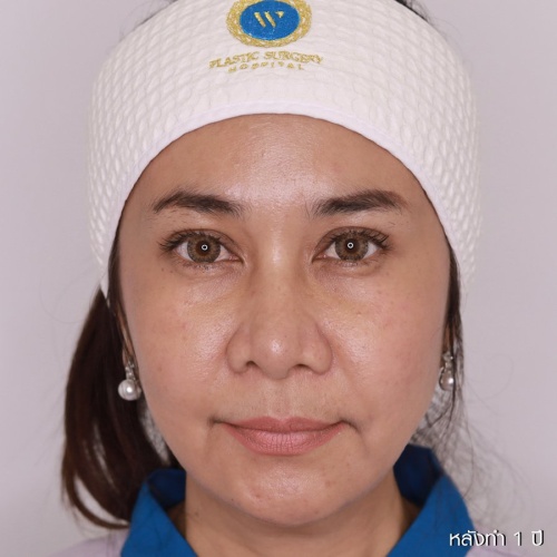 ดึงหน้า