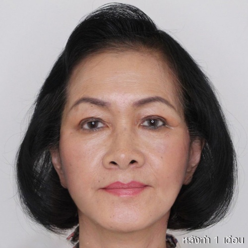 ดึงหน้า