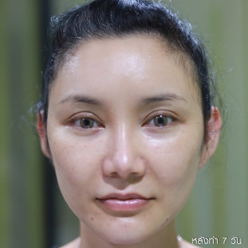 ดึงหน้า