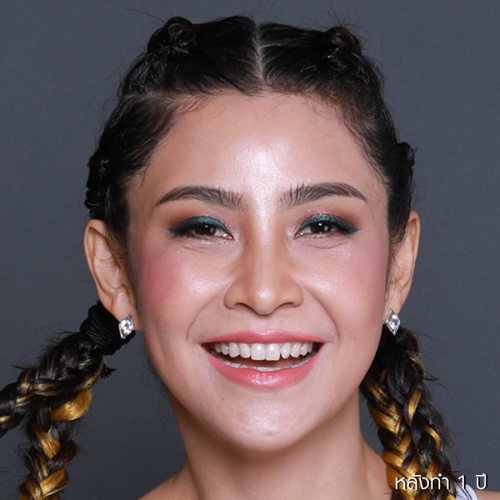 ดูดไขมันเหนียงใต้คาง (FaceTite)