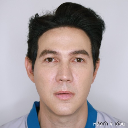 ดูดไขมันเหนียงใต้คาง (FaceTite)