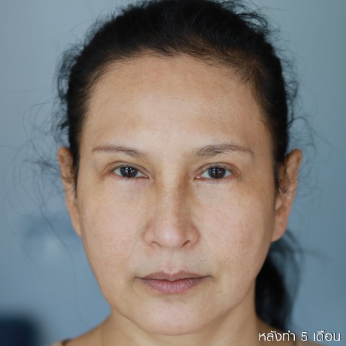 ดึงหน้า