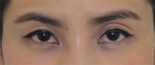 หนังตา/หางตาบนตก