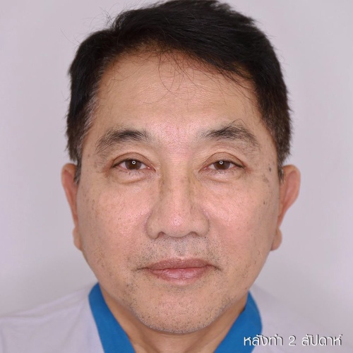 ดึงหน้า