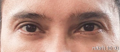 ตัดถุงไขมันใต้ตา