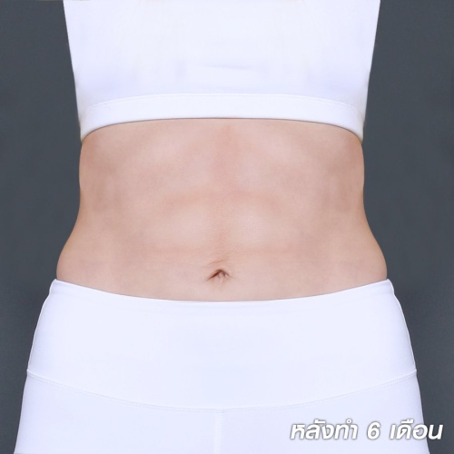 ดูดไขมัน