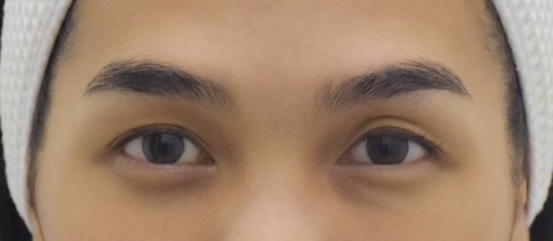 การทำศัลยกรรมตาสองชั้น