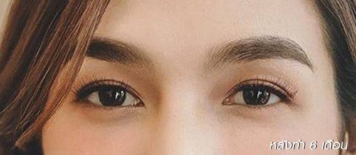 การทำศัลยกรรมตาสองชั้น