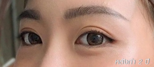 การทำศัลยกรรมตาสองชั้น