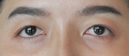 การทำศัลยกรรมตาสองชั้น