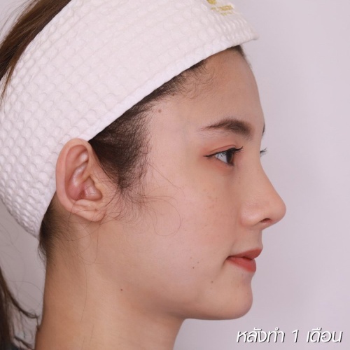 เสริมจมูก