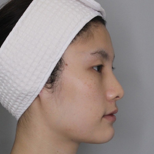 เสริมจมูก