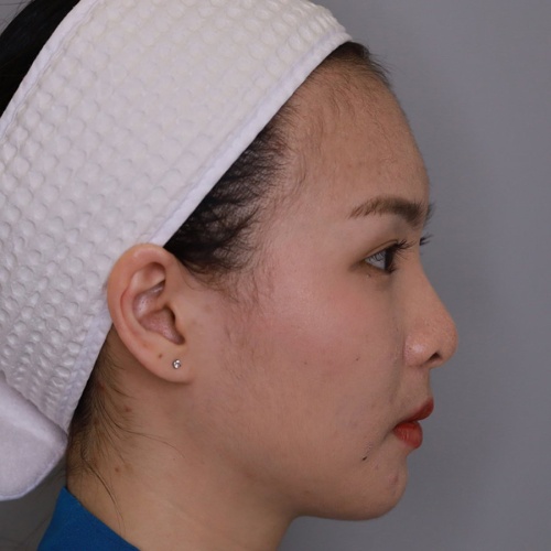 เสริมจมูก