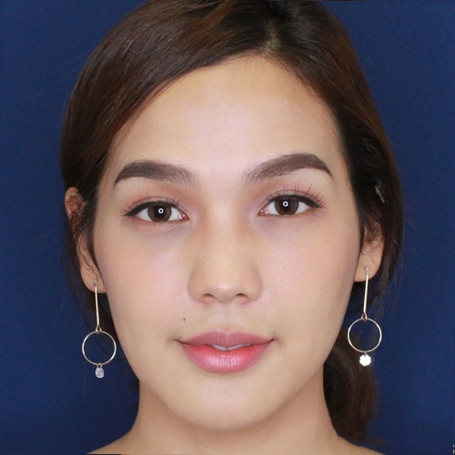 เสริมจมูก