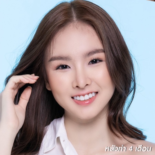 เสริมจมูก