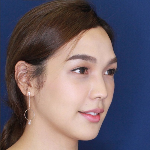 เสริมจมูก