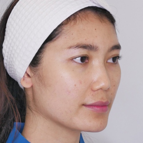 เสริมจมูก