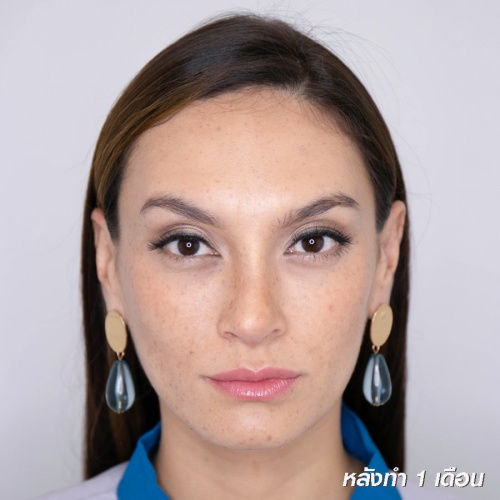 เสริมจมูก