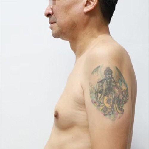 ลดขนาดหน้าอกผู้ชาย