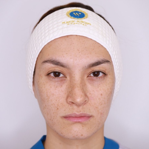 เสริมจมูก