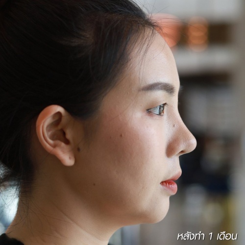 เสริมจมูก