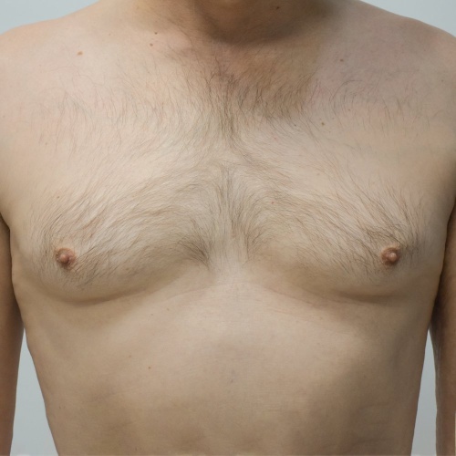 ลดขนาดหน้าอกผู้ชาย