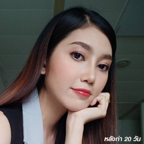 เสริมจมูก