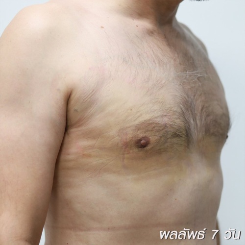 ลดขนาดหน้าอกผู้ชาย