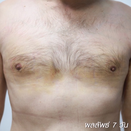 ลดขนาดหน้าอกผู้ชาย