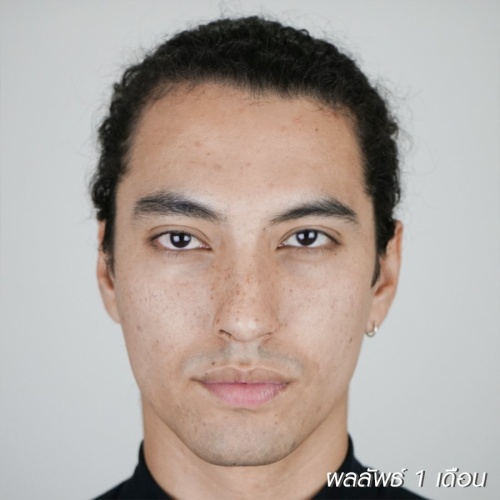 เสริมจมูก