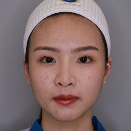 เสริมจมูก