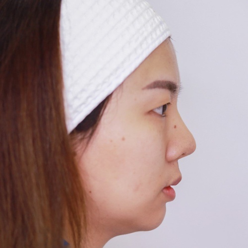 เสริมจมูก