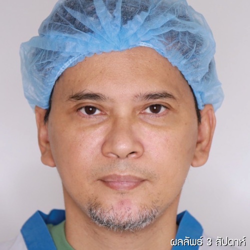 ดึงหน้า