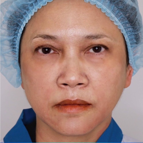 ดึงหน้า