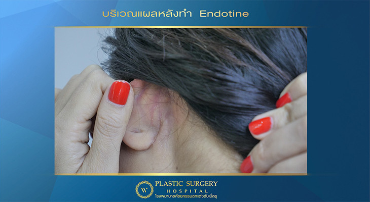 บริเวณแผลหลังทำ Endotine