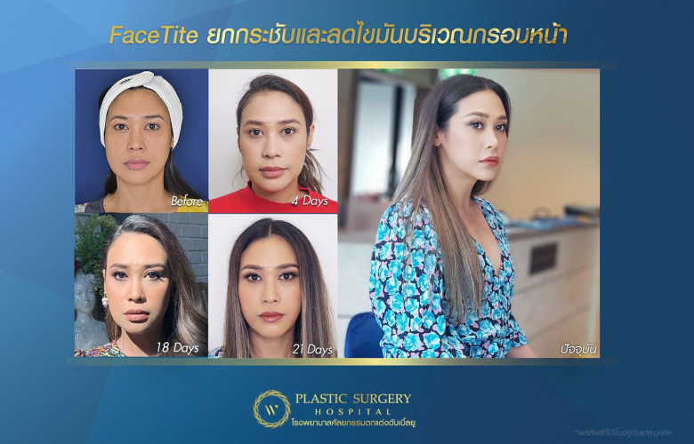 FaceTite ยกกระชับ และลดไขมันบริเวณกรอบหน้า