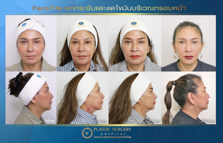 FaceTite ยกกระชับ และลดไขมันบริเวณกรอบหน้า