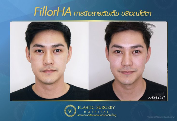 ฉีดสารเติมเต็ม ฉีดฟิลเลอร์ fillor HA