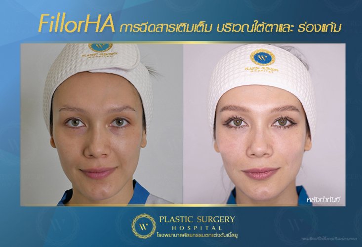 ฉีดสารเติมเต็ม ฉีดฟิลเลอร์ fillor HA
