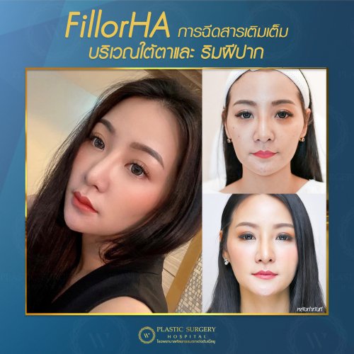 ฉีดสารเติมเต็ม ฉีดฟิลเลอร์ fillor HA