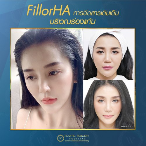 ฉีดสารเติมเต็ม ฉีดฟิลเลอร์ fillor HA