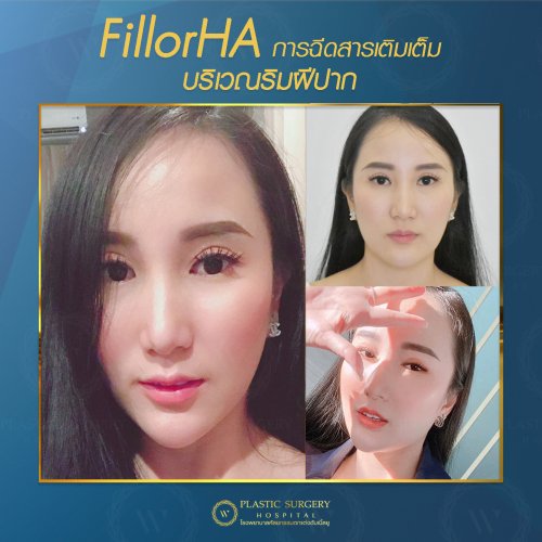 ฉีดสารเติมเต็ม ฉีดฟิลเลอร์ fillor HA