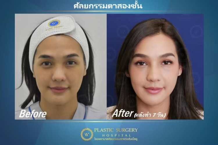 รีวิวทำตาสองชั้น โรงพยาบาลศัลยกรรมตกแต่งดับเบิ้ลยู