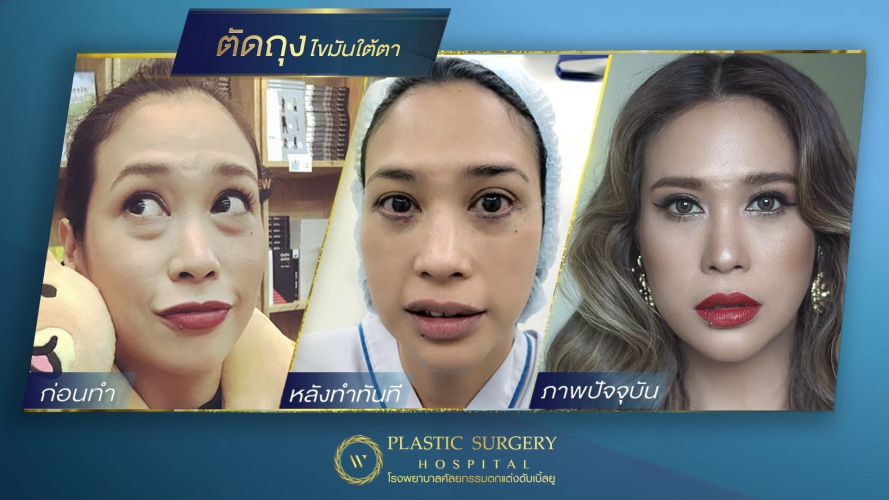 รีวิวผ่าถุงไขมันใต้ตา ศัลยกรรมเปลือกตาล่าง โรงพยาบาลศัลยกรรมตกแต่งดับเบิ้ลยู