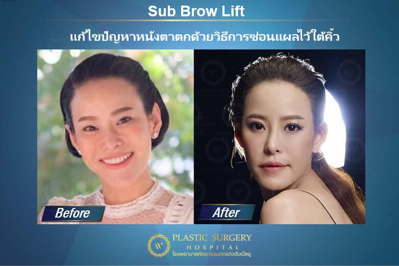 Brow Lift