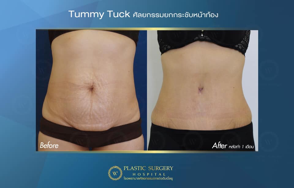 TummyTuck